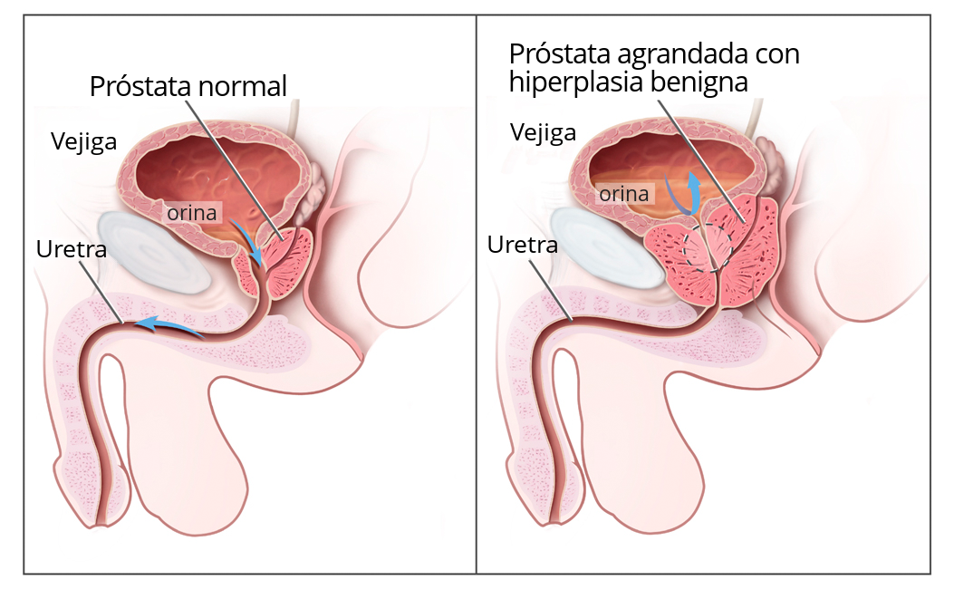 BPH es hiperplasia benigna de prostata