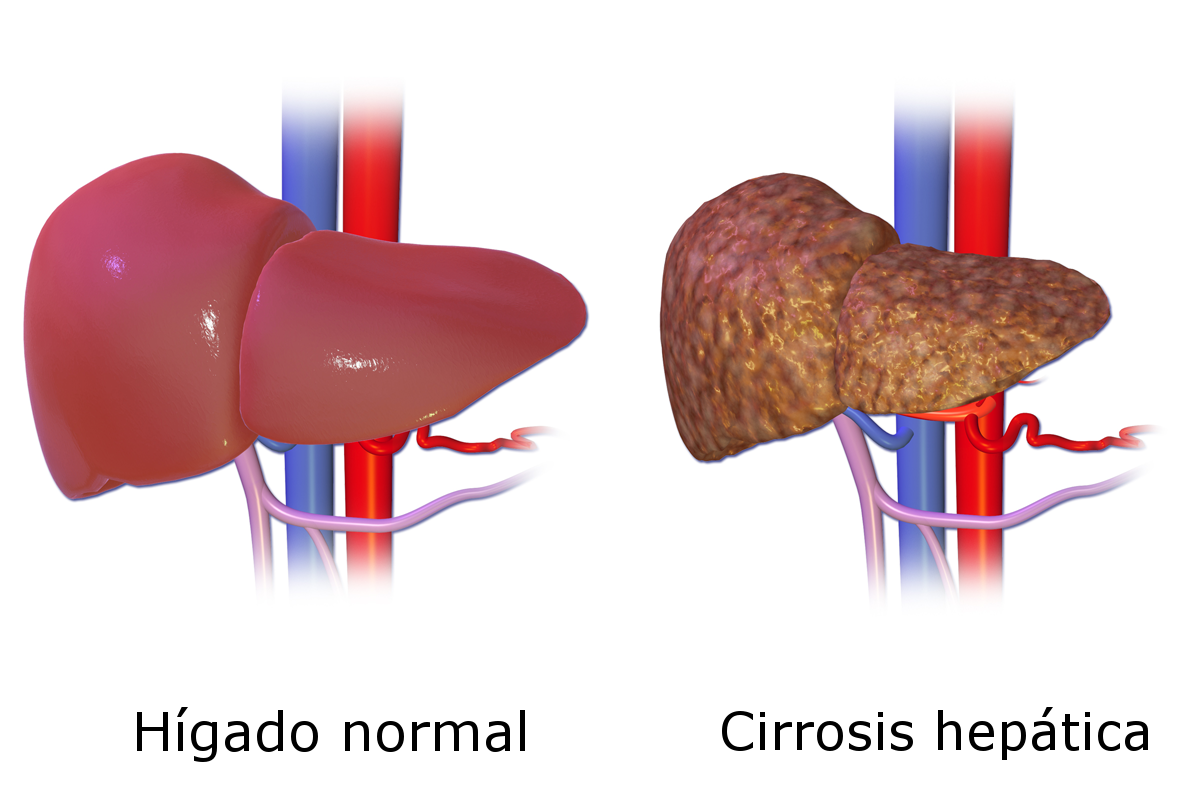 Liver Cirrhosis es