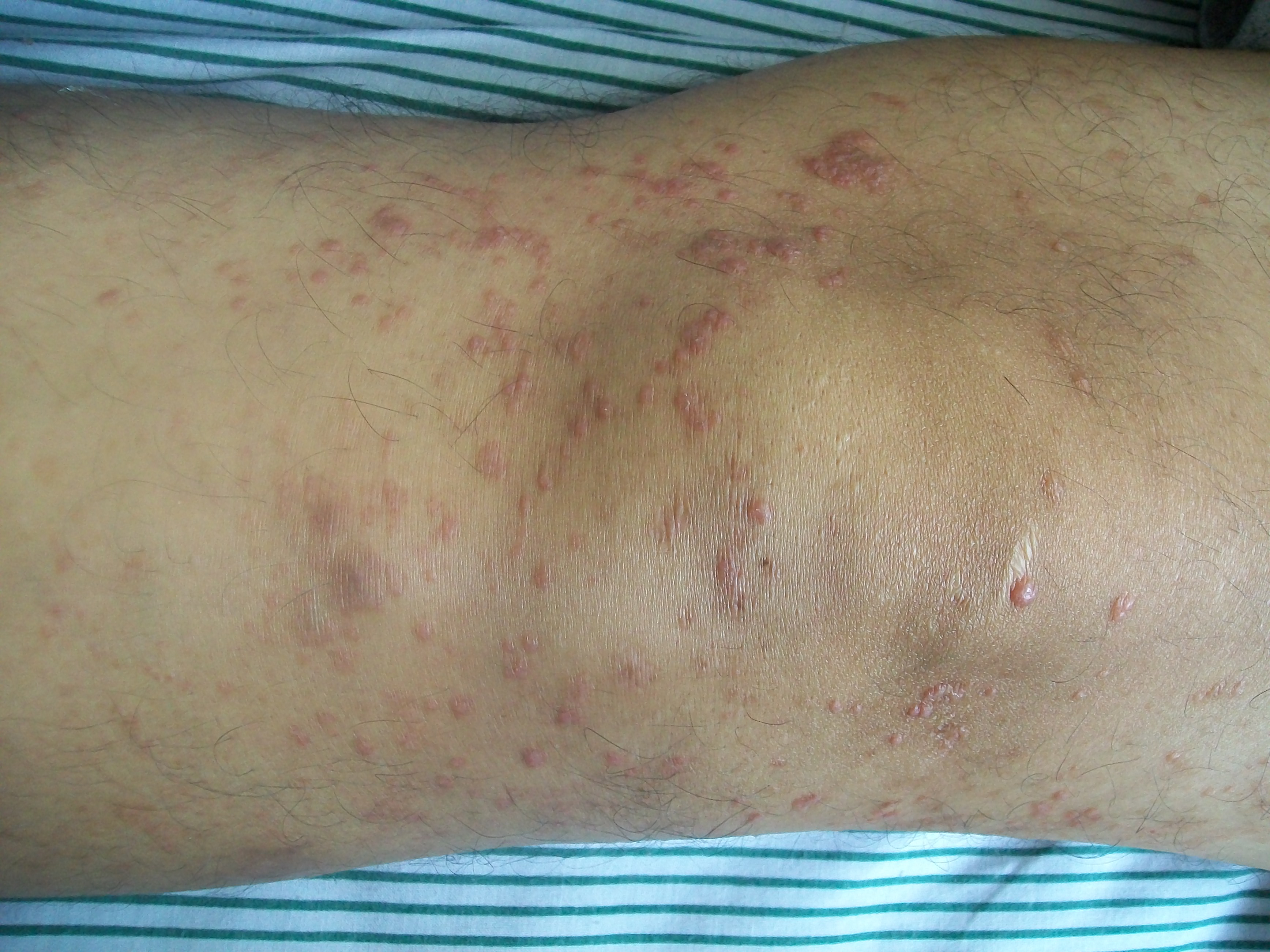 Mycosis fungoides knee