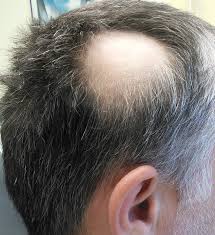 alopecia1